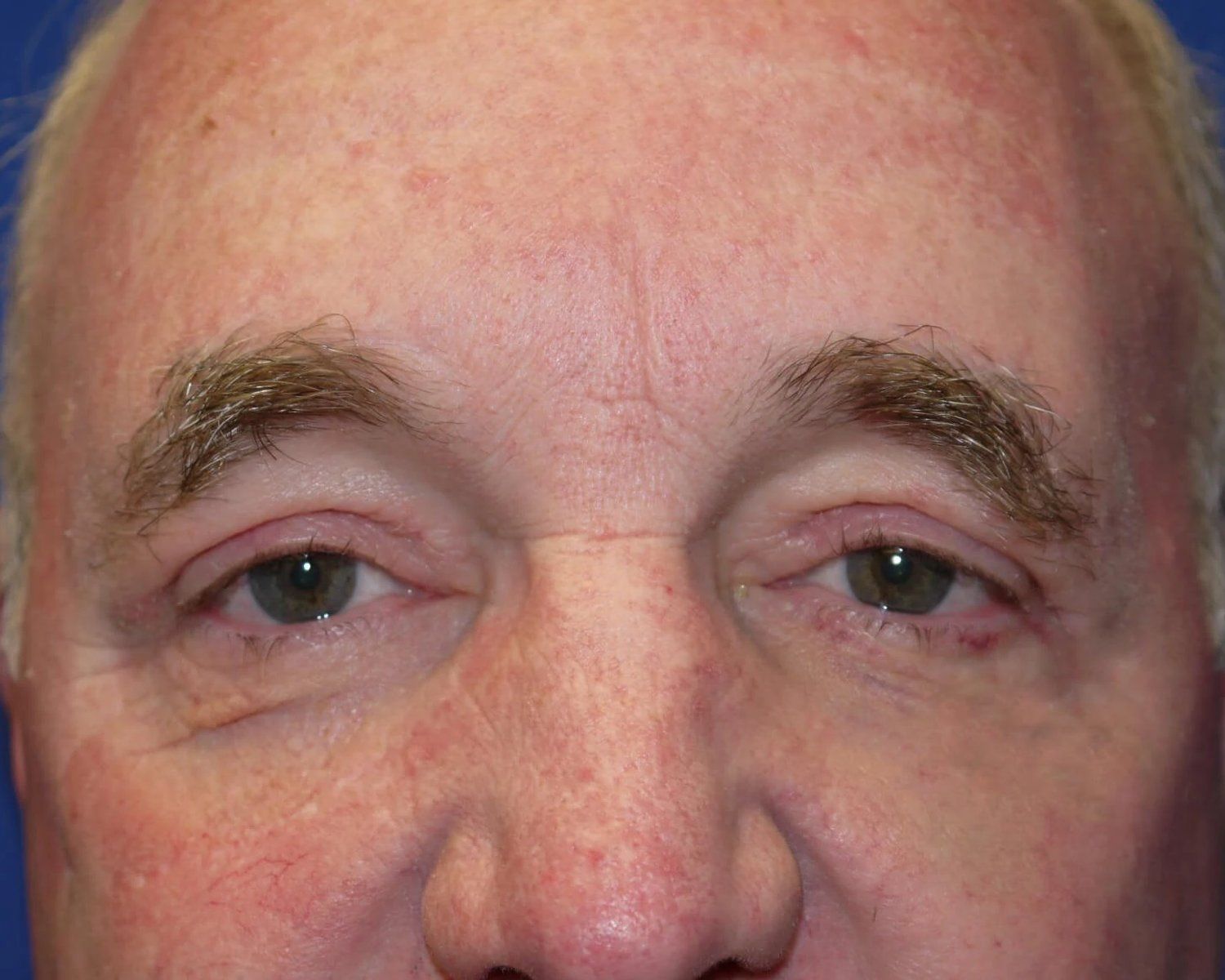 Eyelid Surgery after