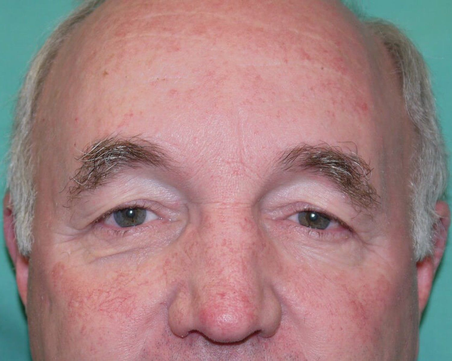 Eyelid Surgery before