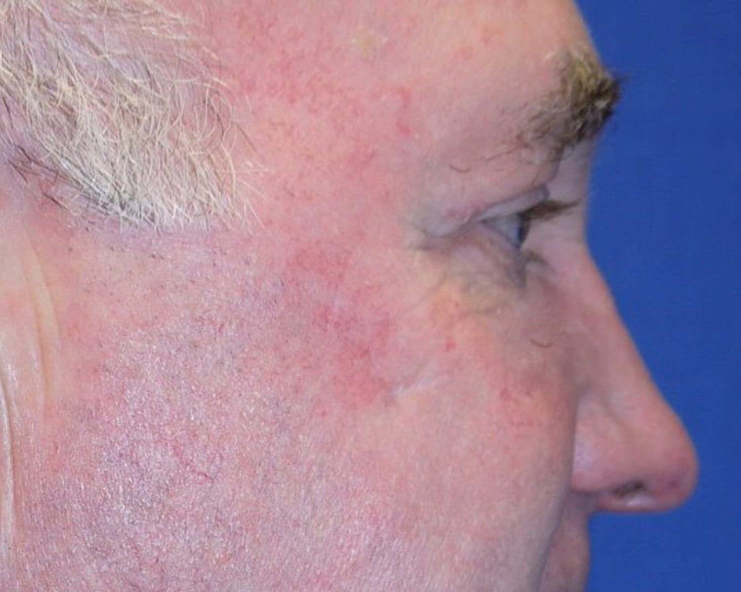 Eyelid Surgery, Oblique Right view, after
