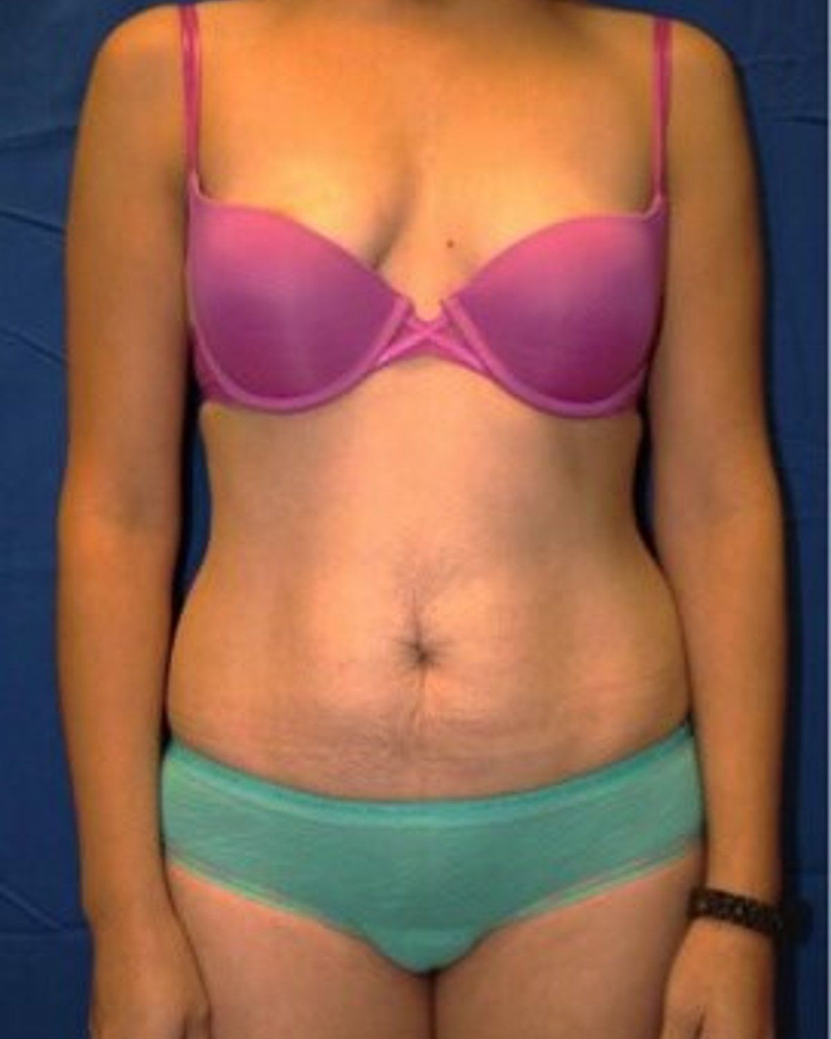 Tummy Tuck before