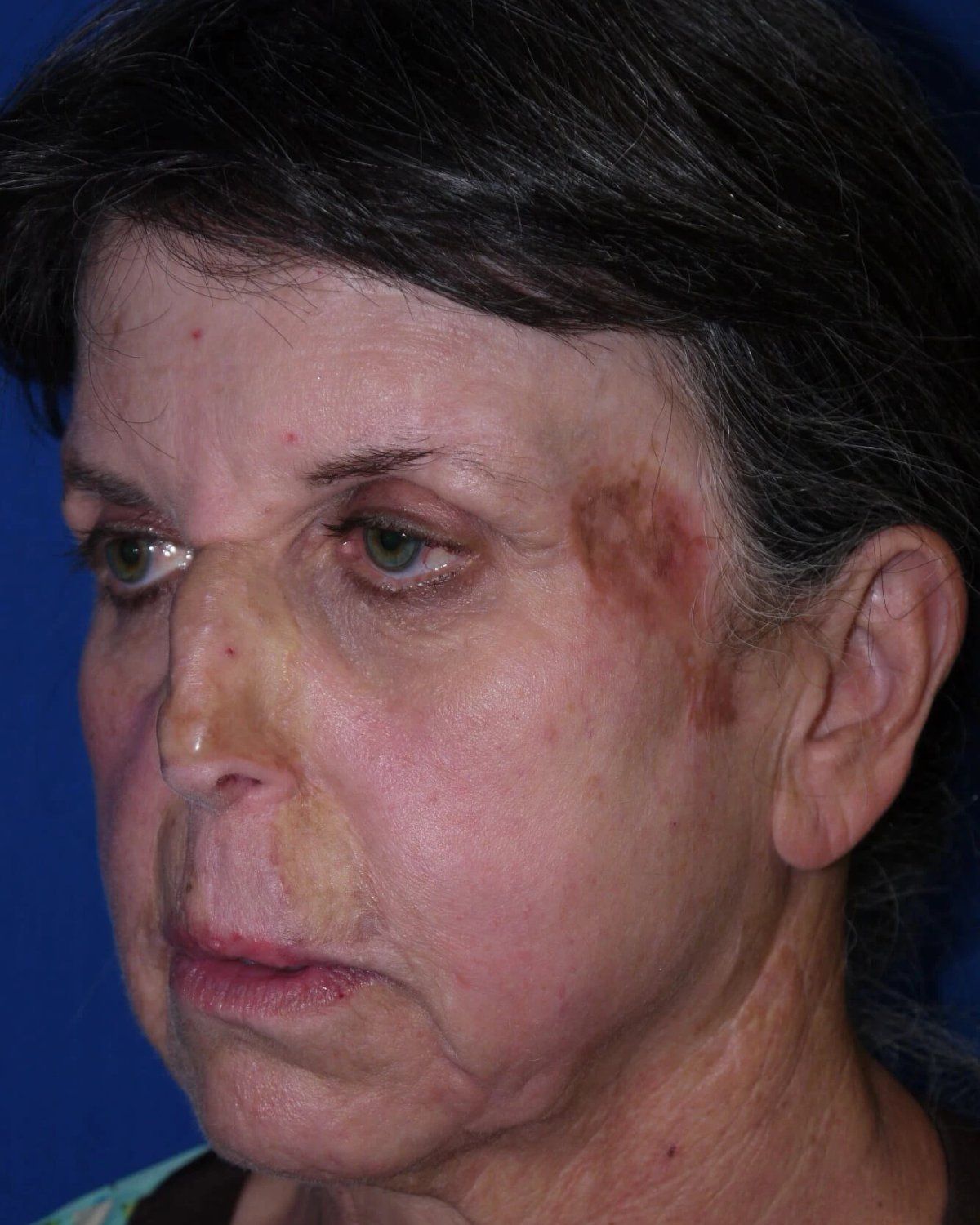 Facelift (neck lift included) before