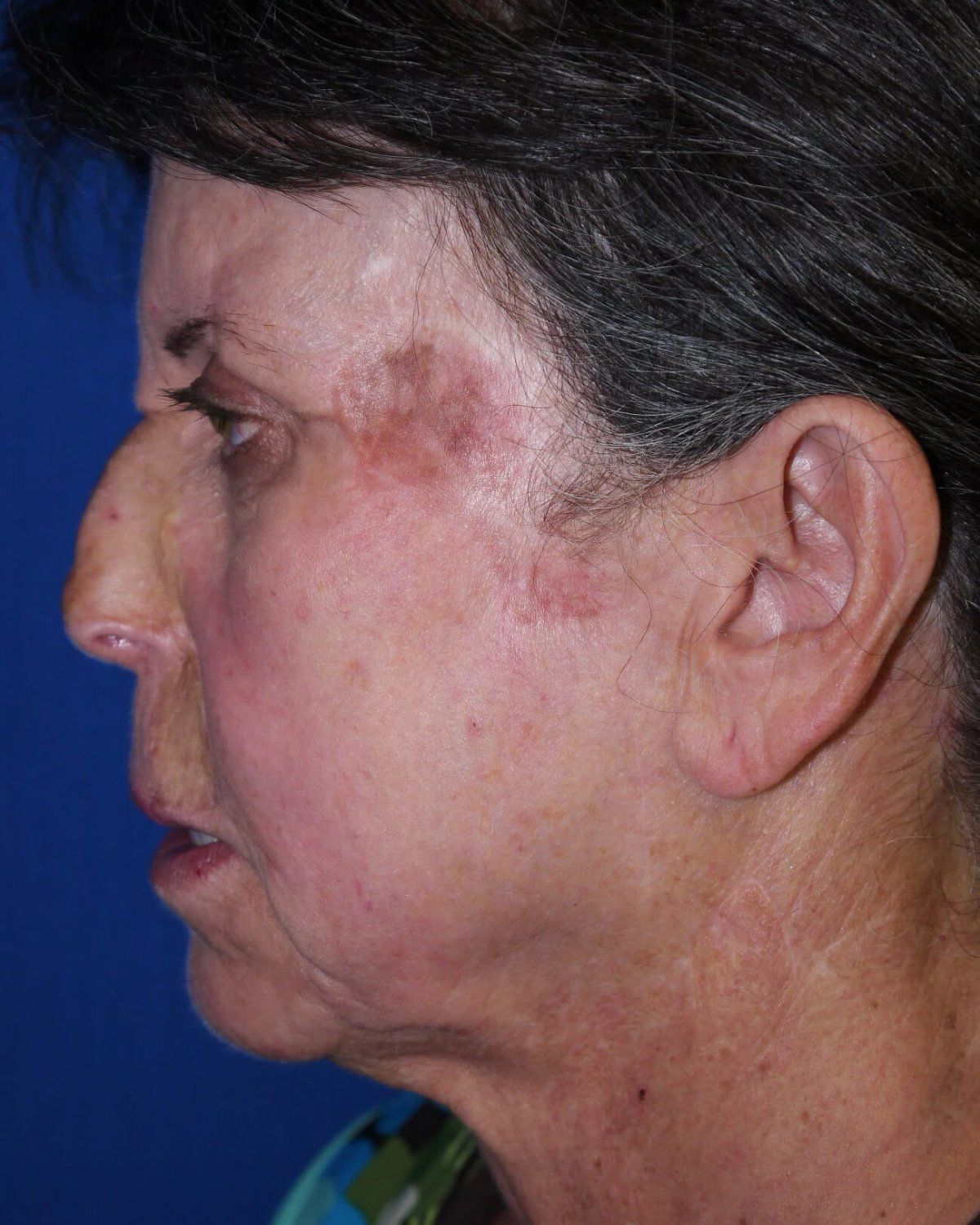 Facelift (neck lift included) — Left Profile view, before