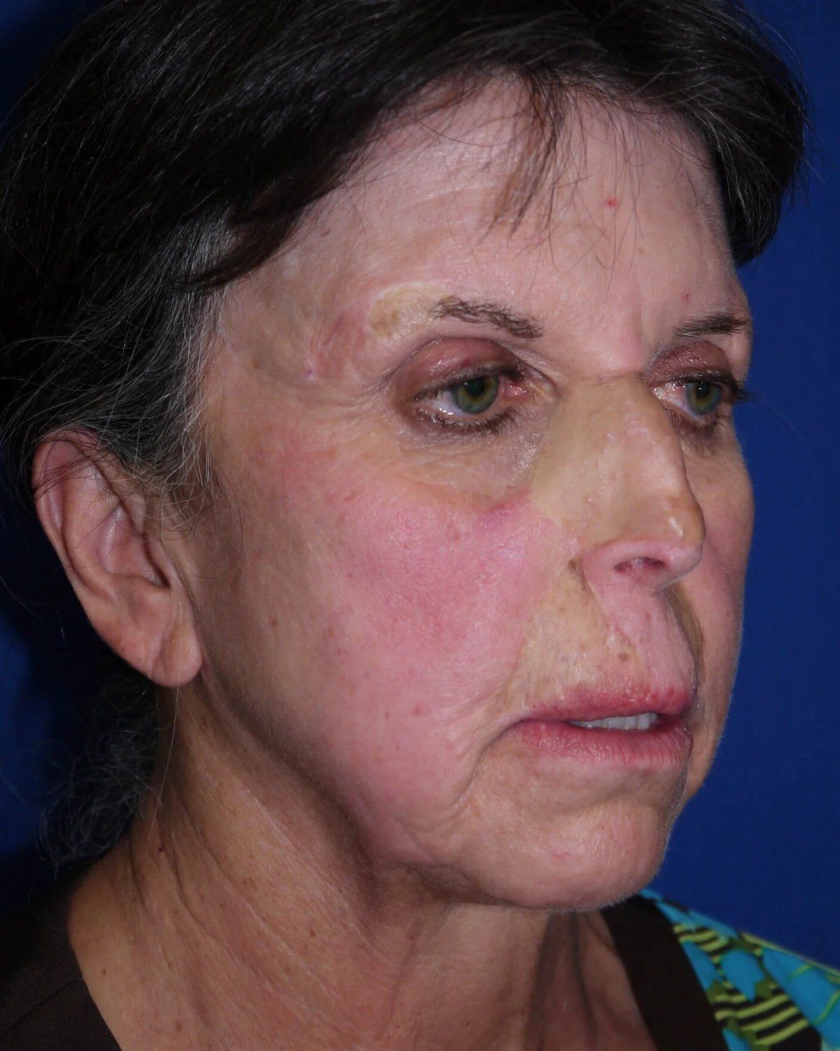 Facelift (neck lift included) — Oblique Right view, before
