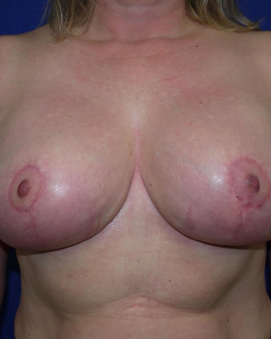After Breast Reduction