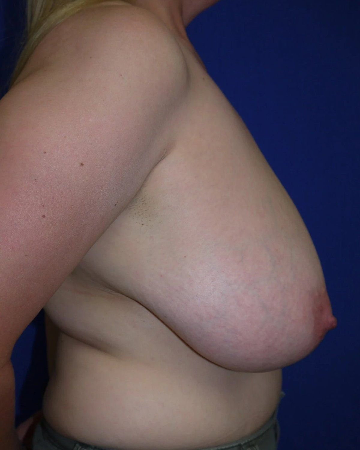Breast Reduction, Right Profile view, before