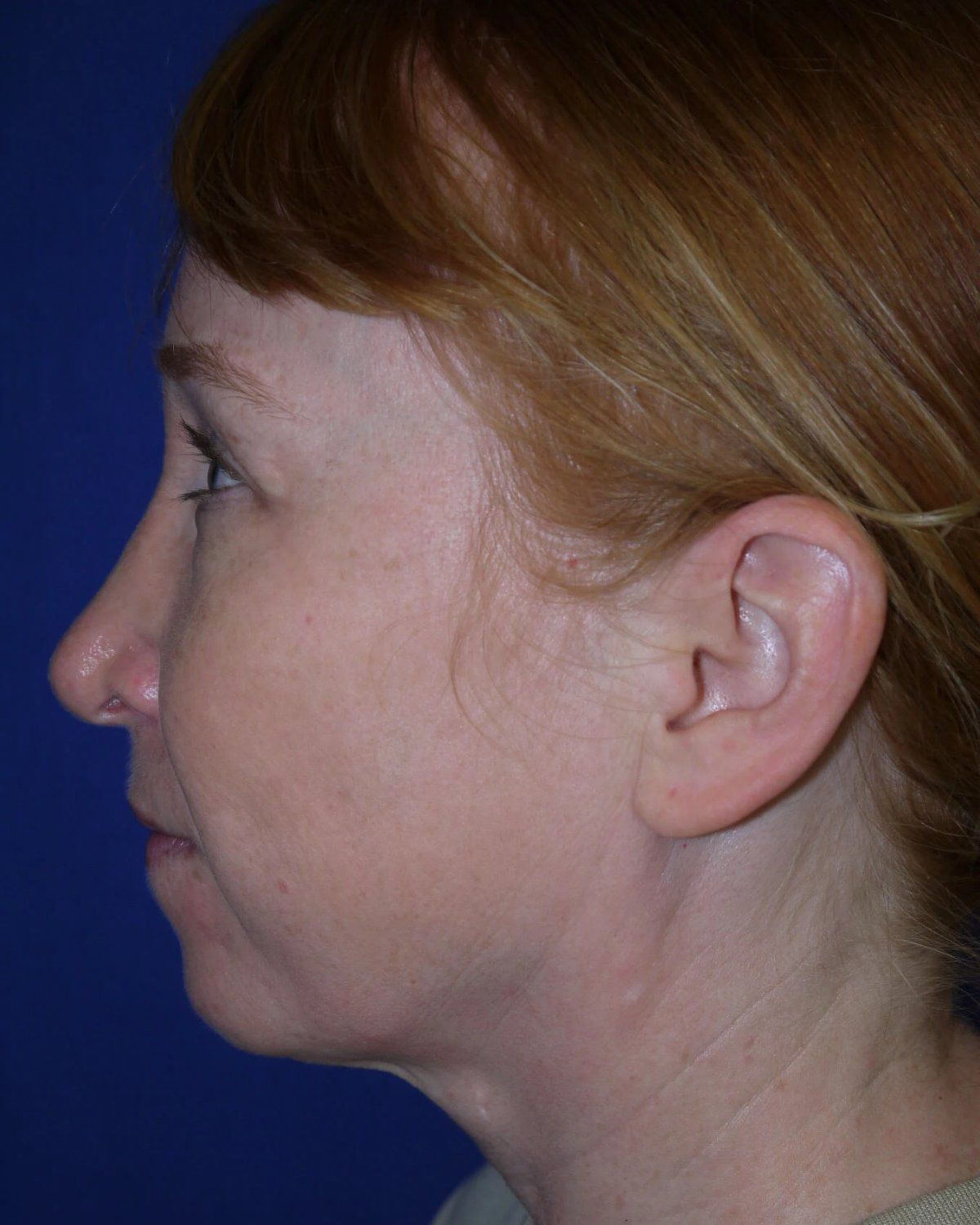 Facelift (neck lift included) — Oblique Left view, before