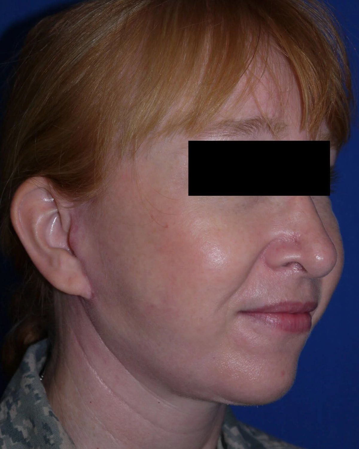 Facelift (neck lift included) after