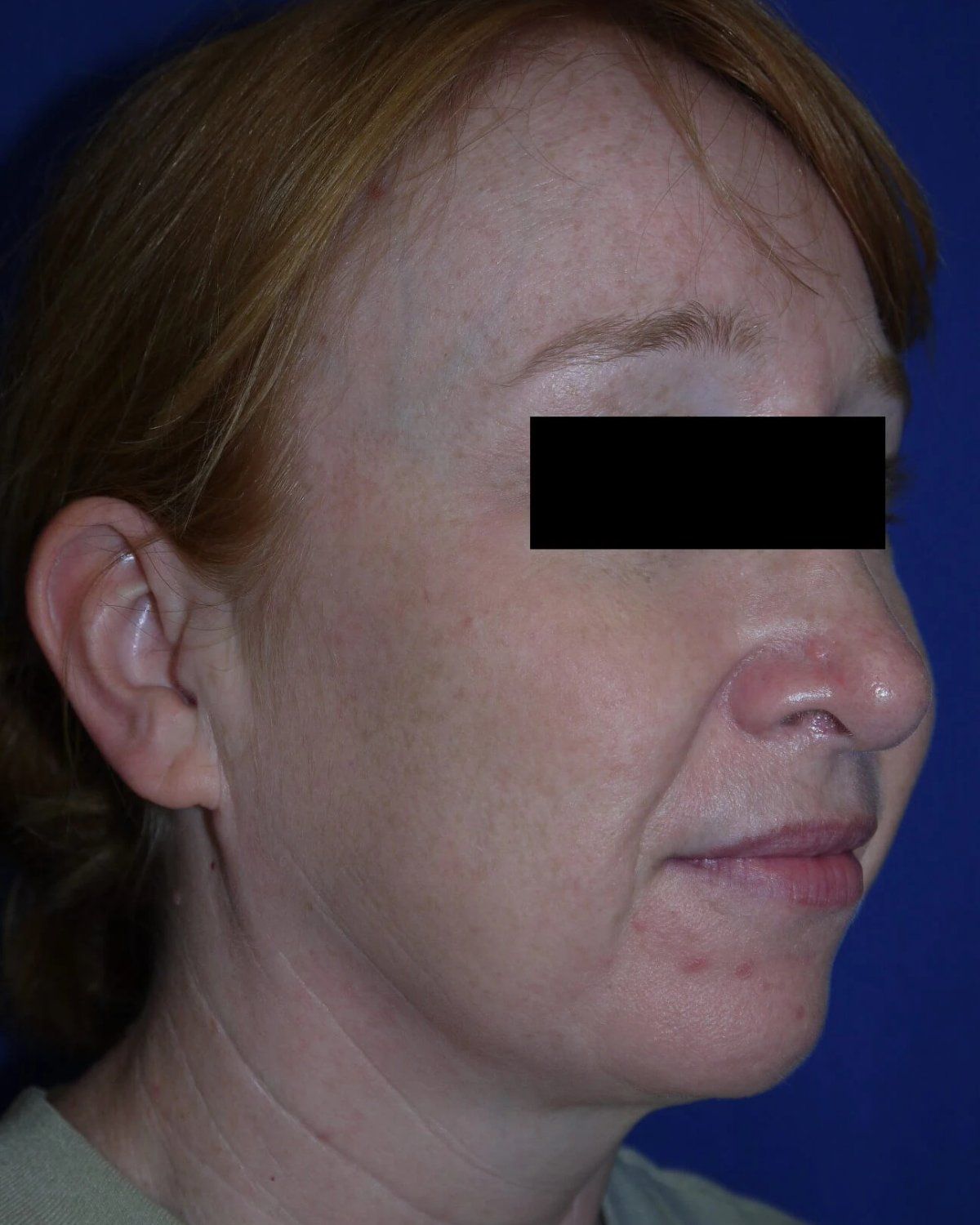 Facelift (neck lift included) before