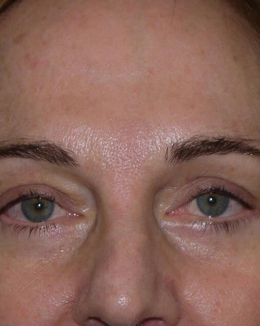 After Eyelid Surgery