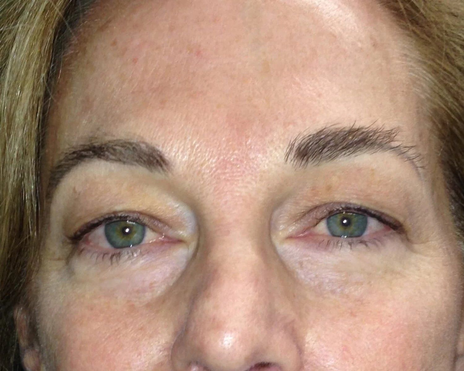 Eyelid Surgery before