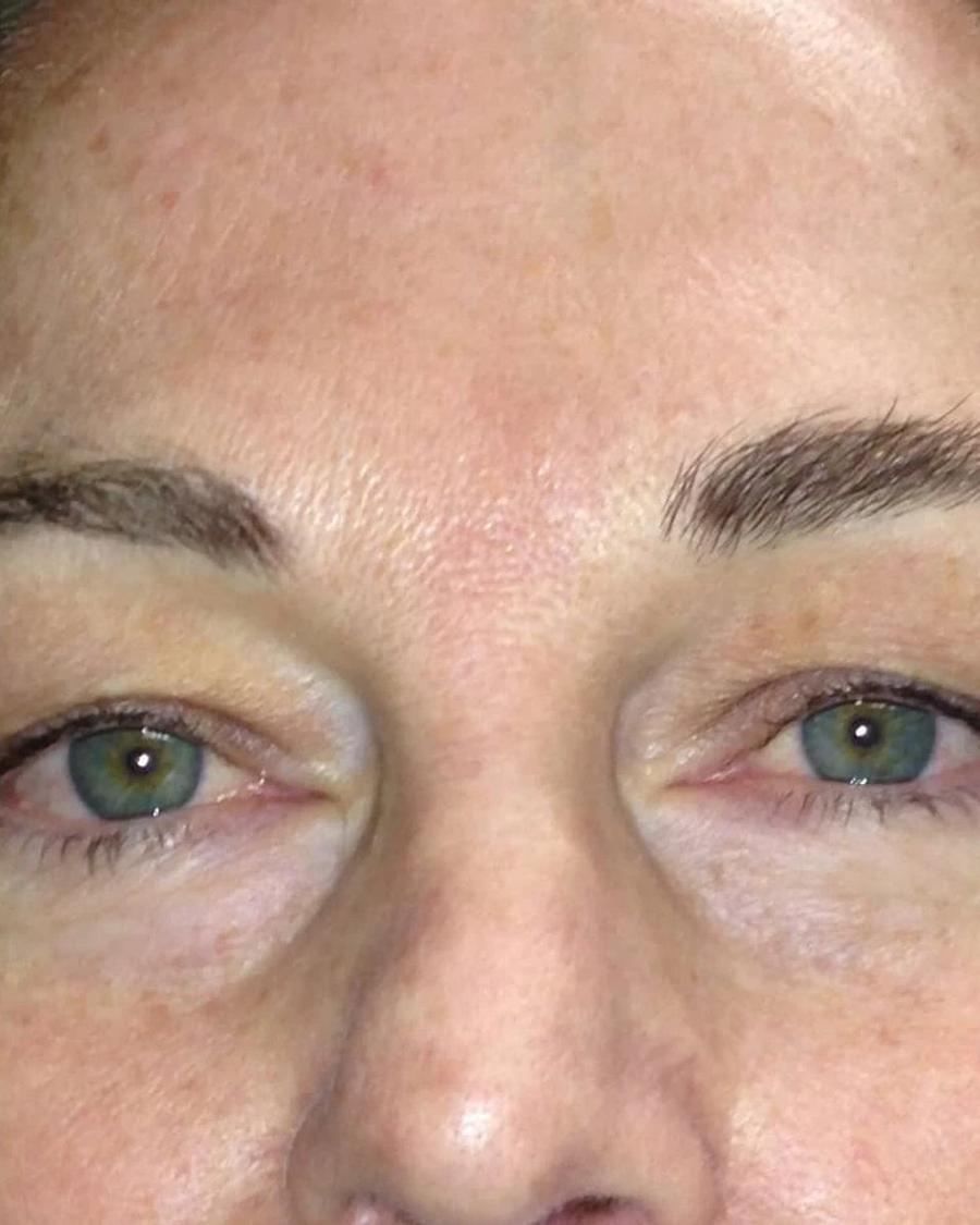 Before Eyelid Surgery