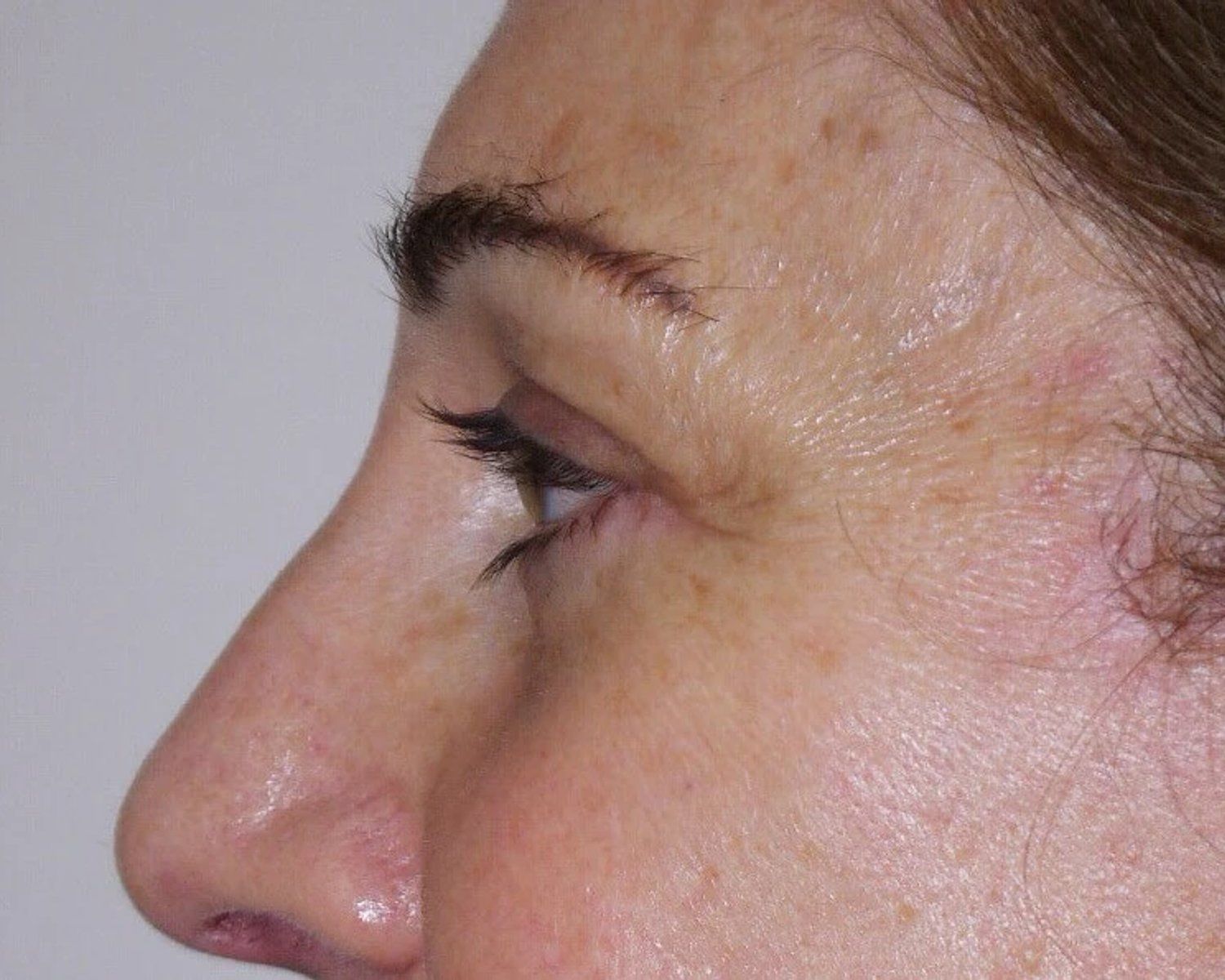 Eyelid Surgery, Oblique Left view, after