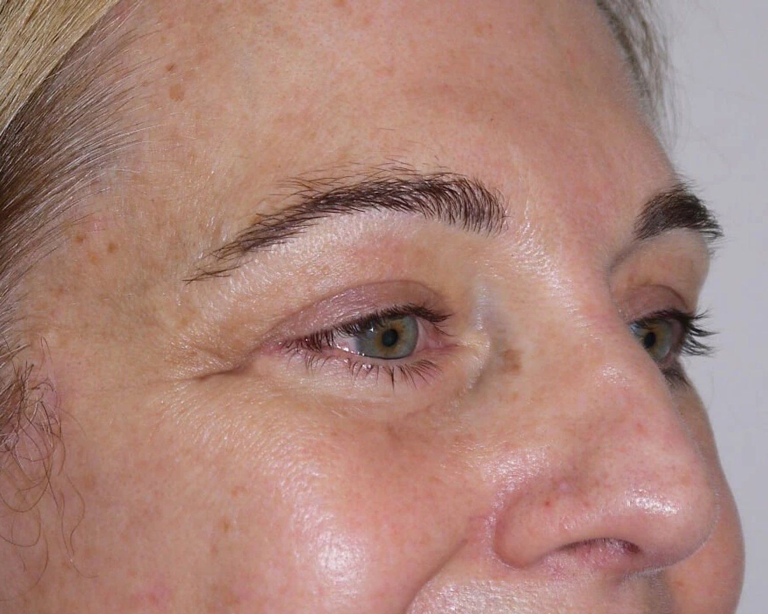 Eyelid Surgery, Oblique Right view, after