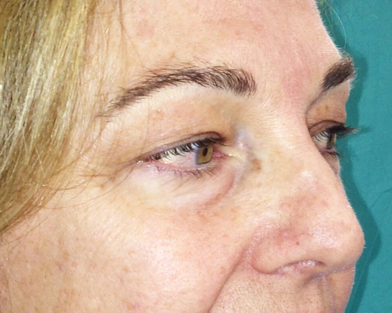 Eyelid Surgery, Oblique Right view, before