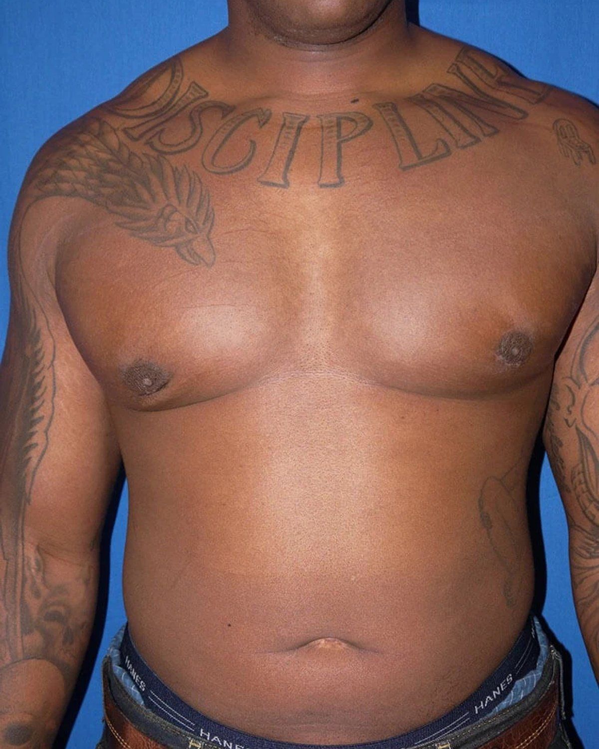 One-Stitch Gynecomastia after
