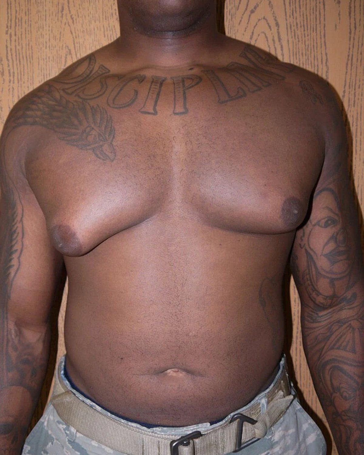 One-Stitch Gynecomastia before