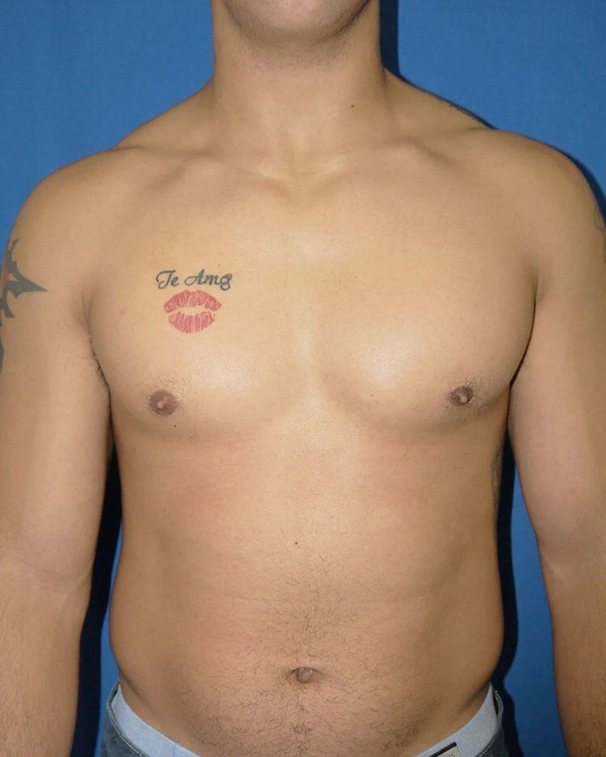 One-Stitch Gynecomastia after