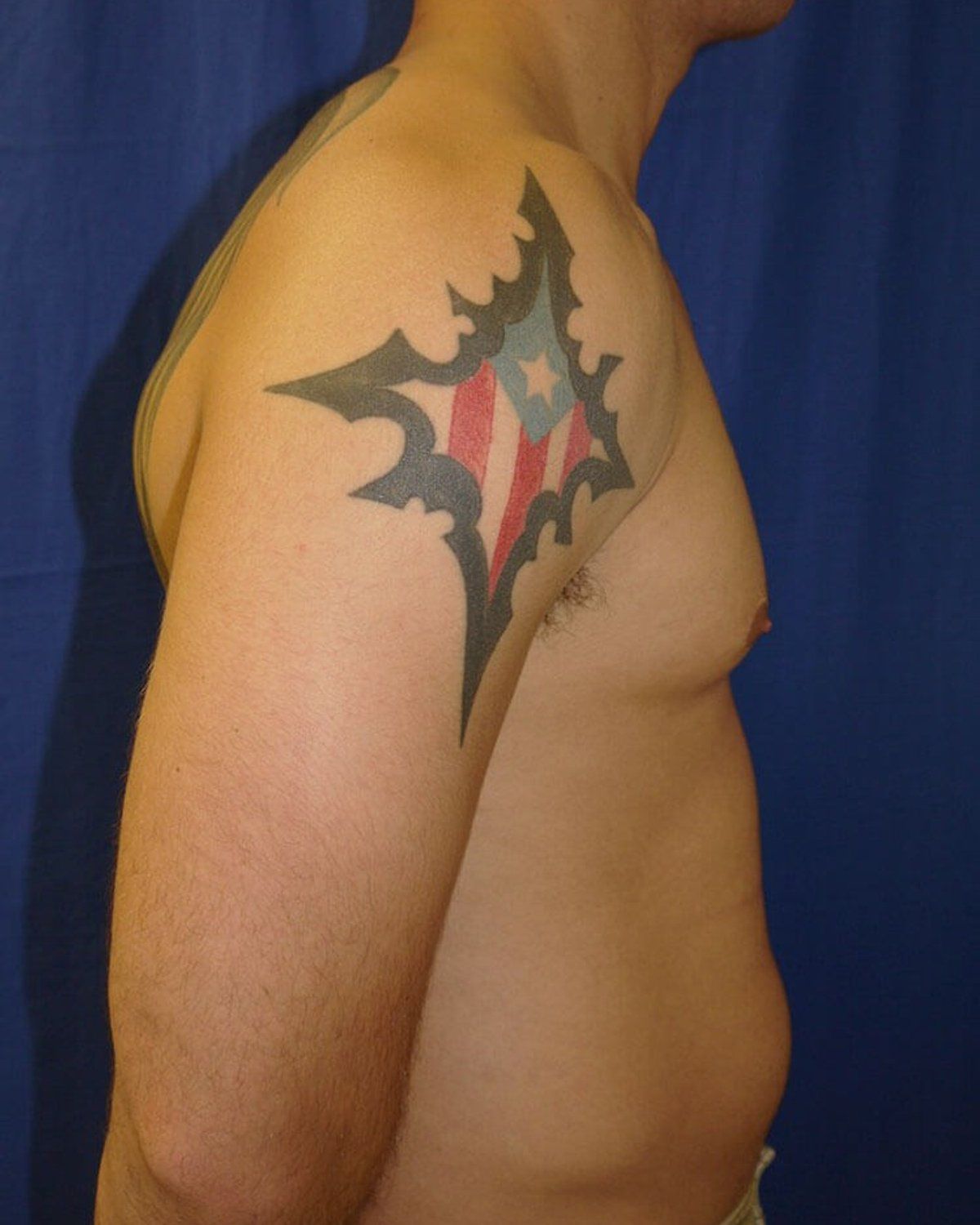 One-Stitch Gynecomastia — Oblique Right view, before
