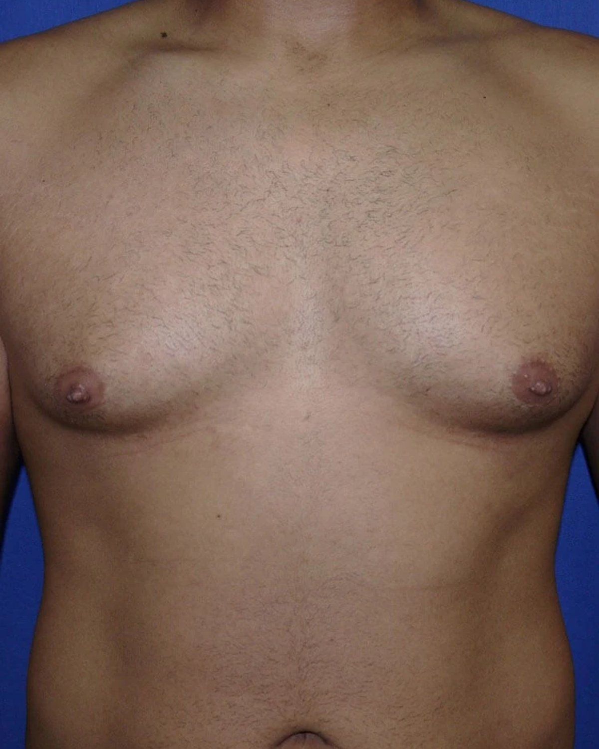 One-Stitch Gynecomastia before