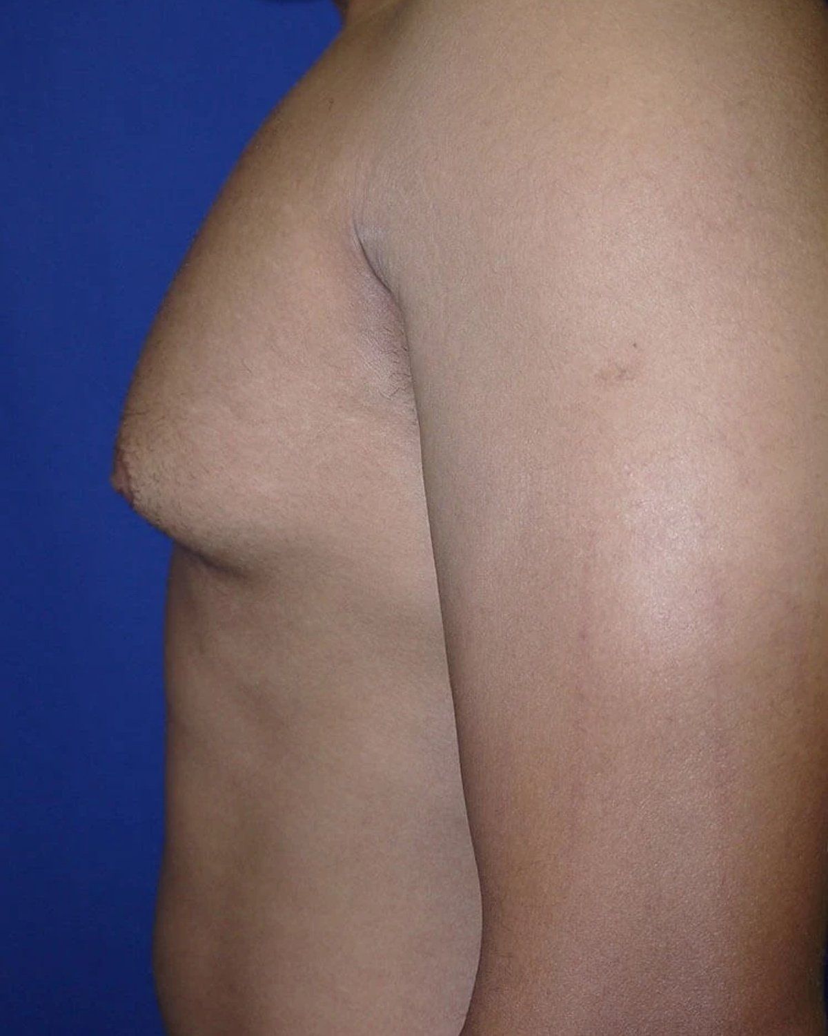One-Stitch Gynecomastia — Left Profile view, before
