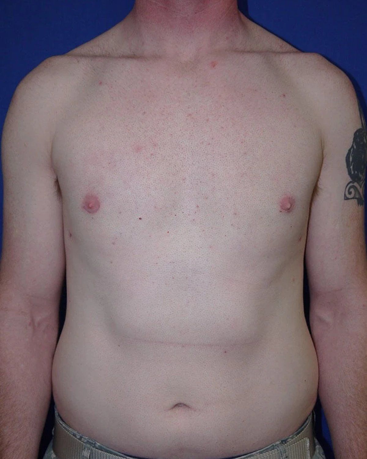 One-Stitch Gynecomastia after