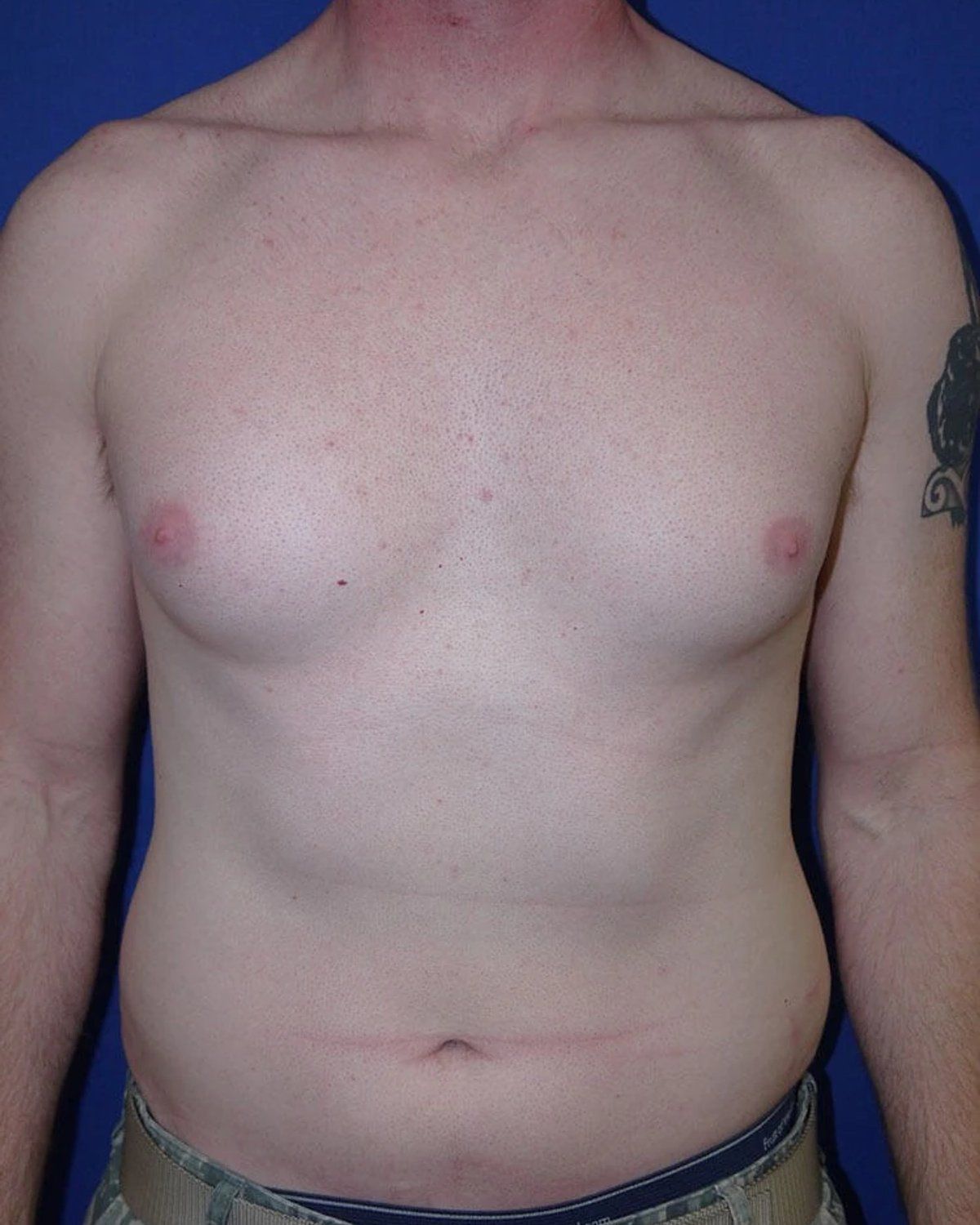 One-Stitch Gynecomastia before
