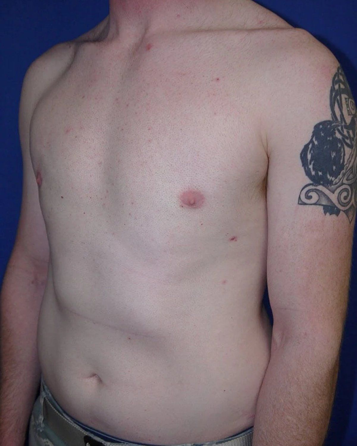 One-Stitch Gynecomastia — Oblique Right view, after