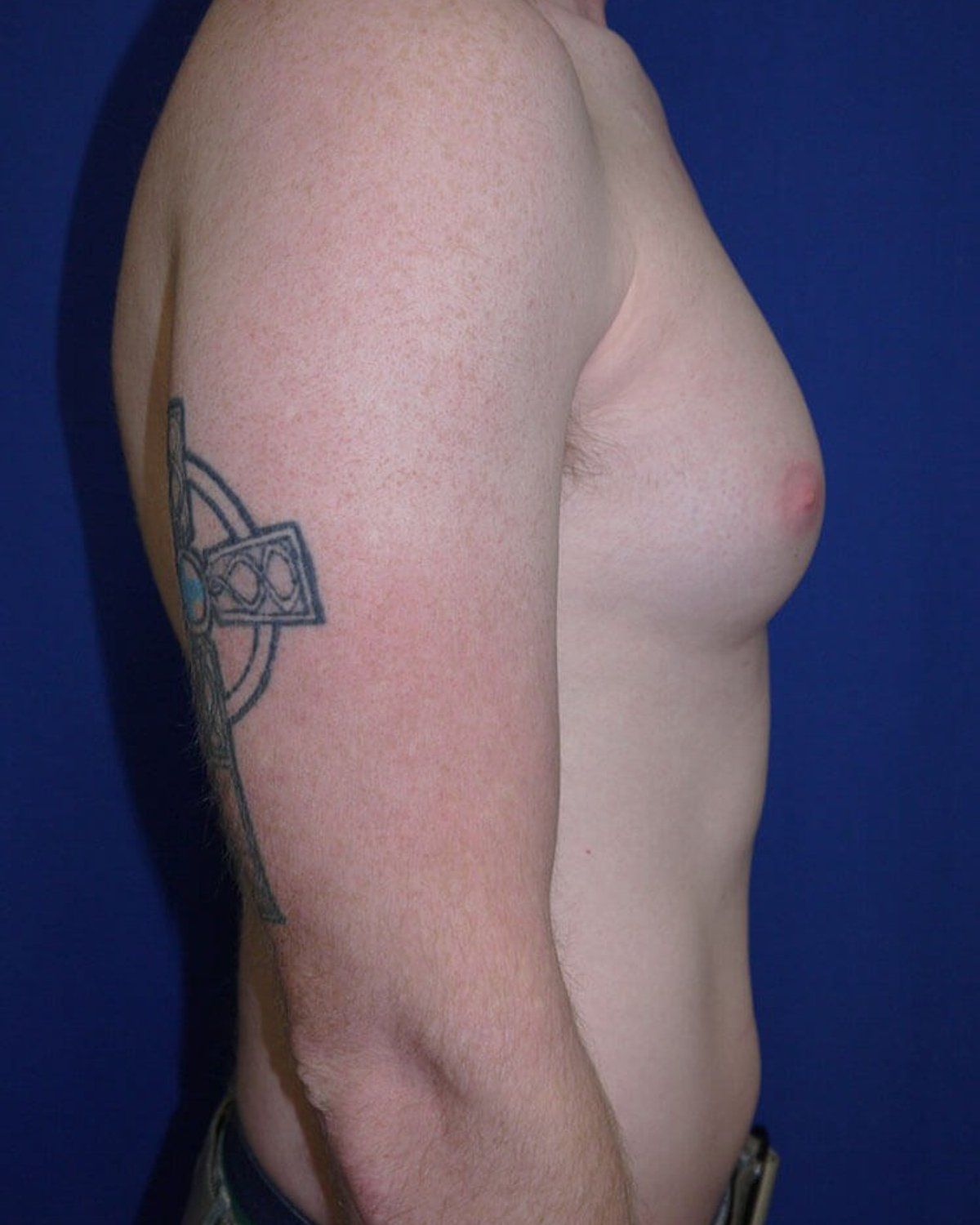 One-Stitch Gynecomastia — Right Profile view, before