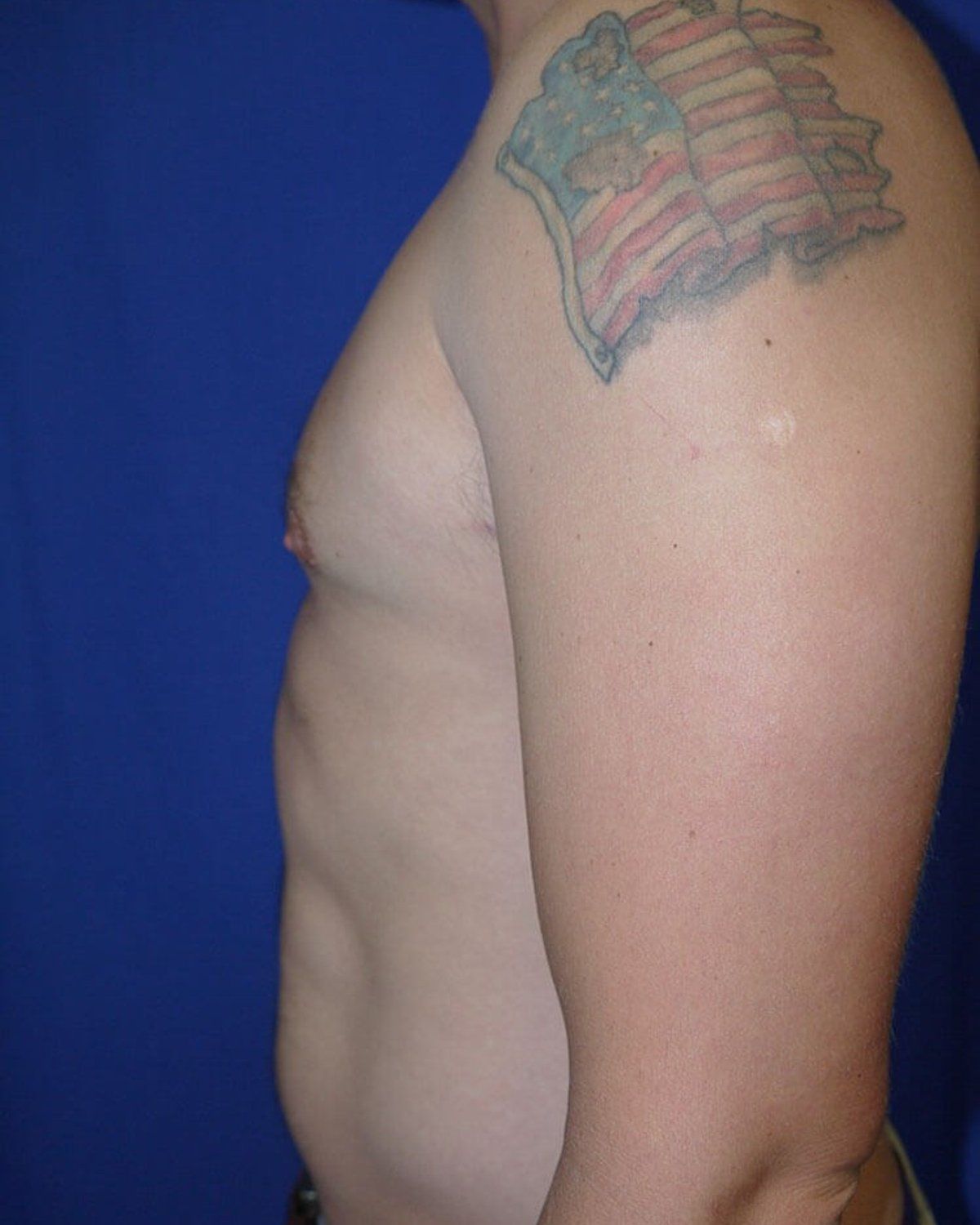 One-Stitch Gynecomastia — Left Profile view, after