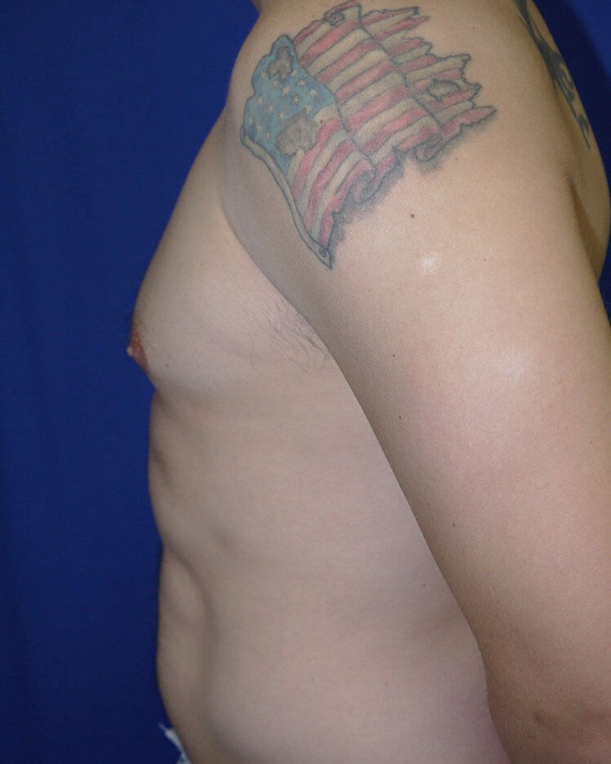One-Stitch Gynecomastia — Left Profile view, before