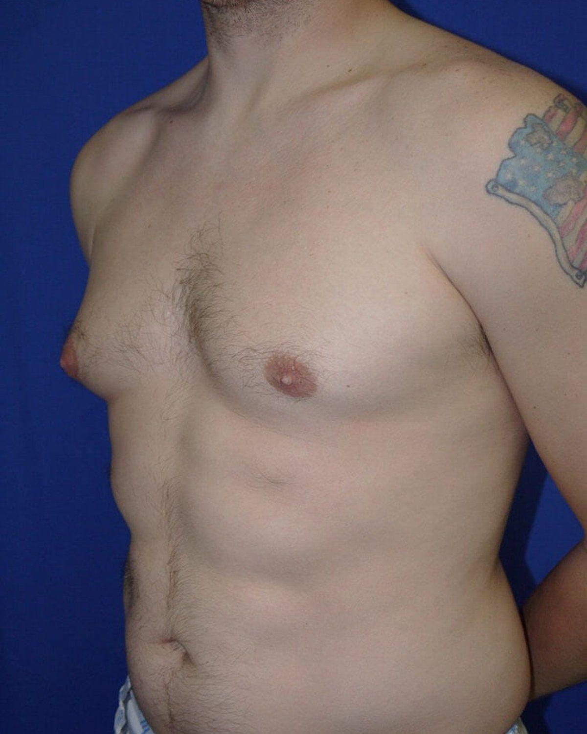 One-Stitch Gynecomastia — Oblique Right view, before