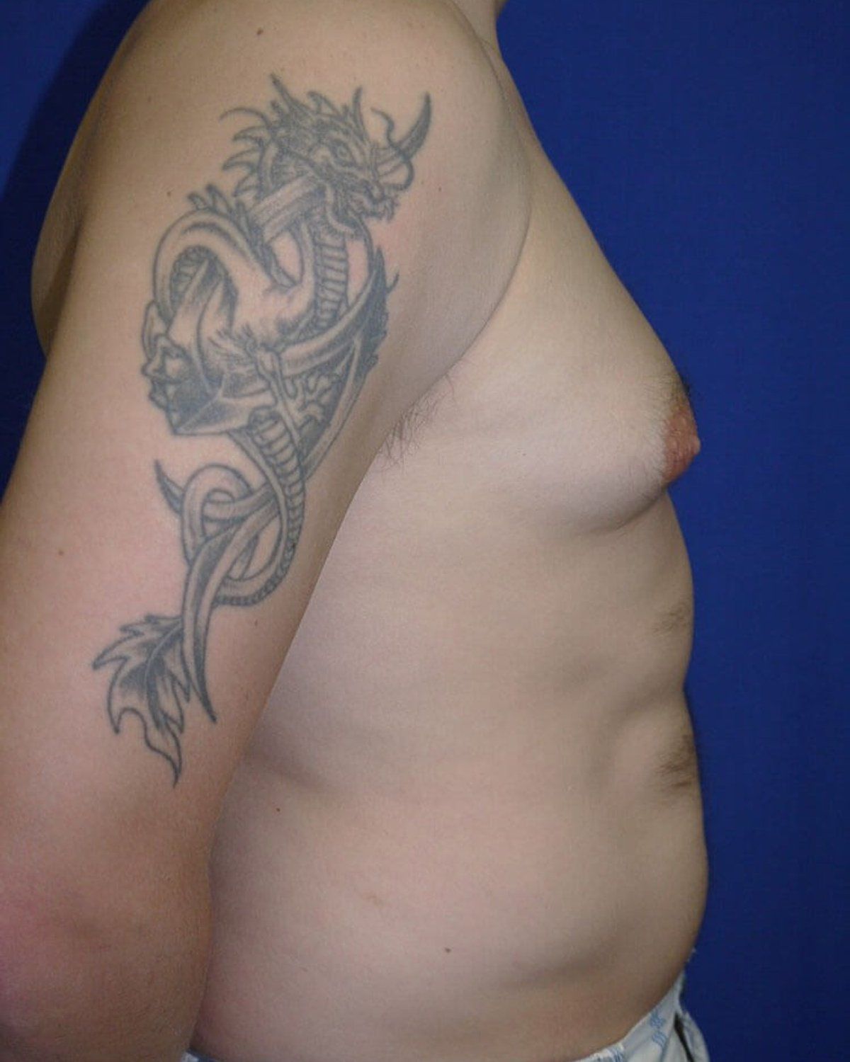 One-Stitch Gynecomastia — Right Profile view, before
