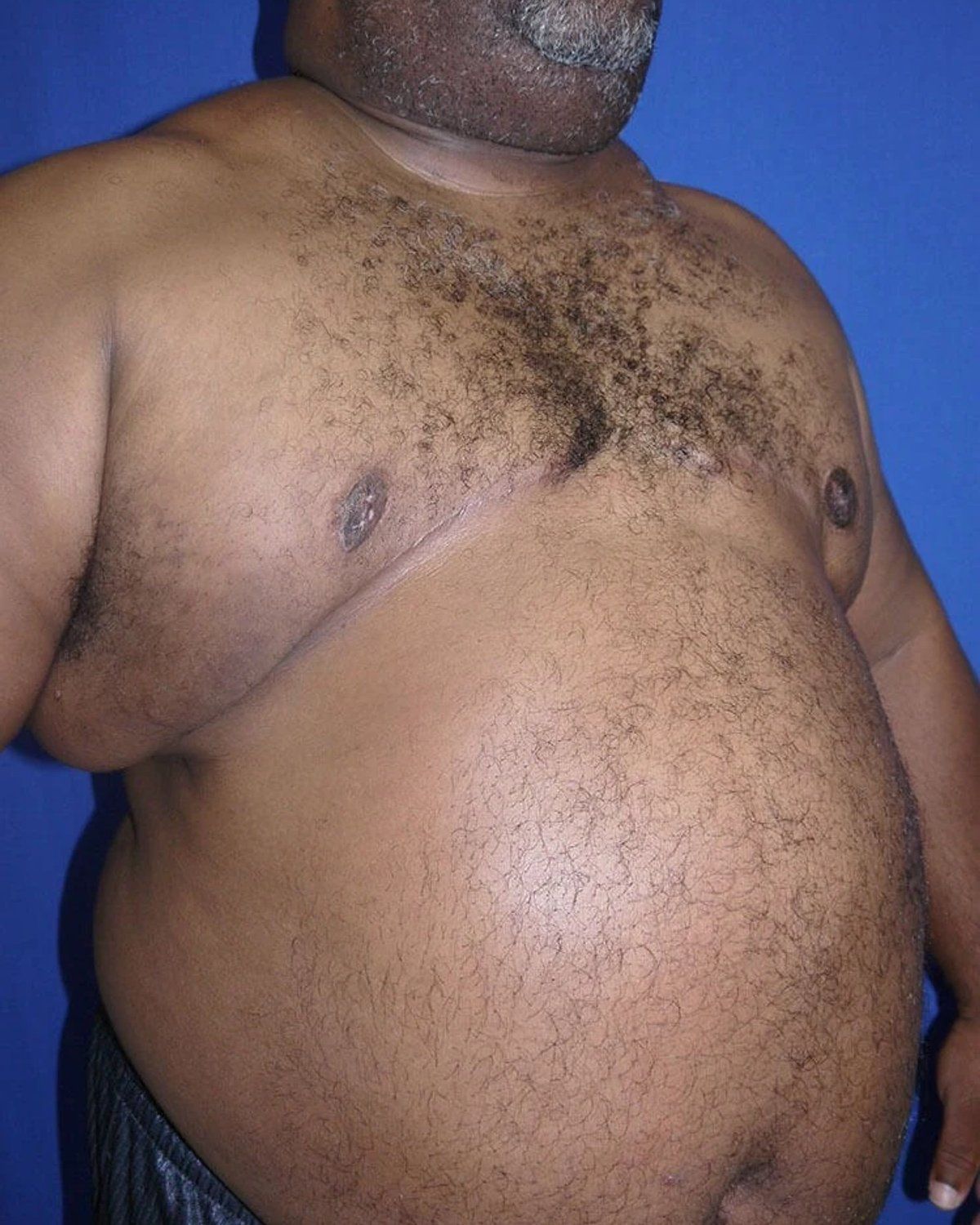 One-Stitch Gynecomastia — Oblique Right view, after