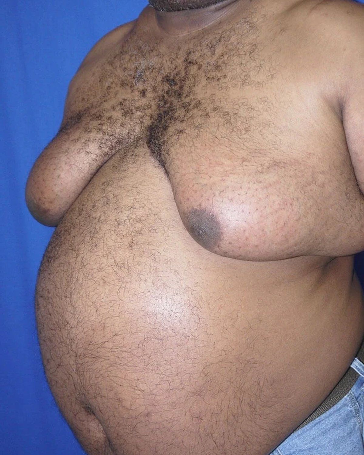 One-Stitch Gynecomastia before
