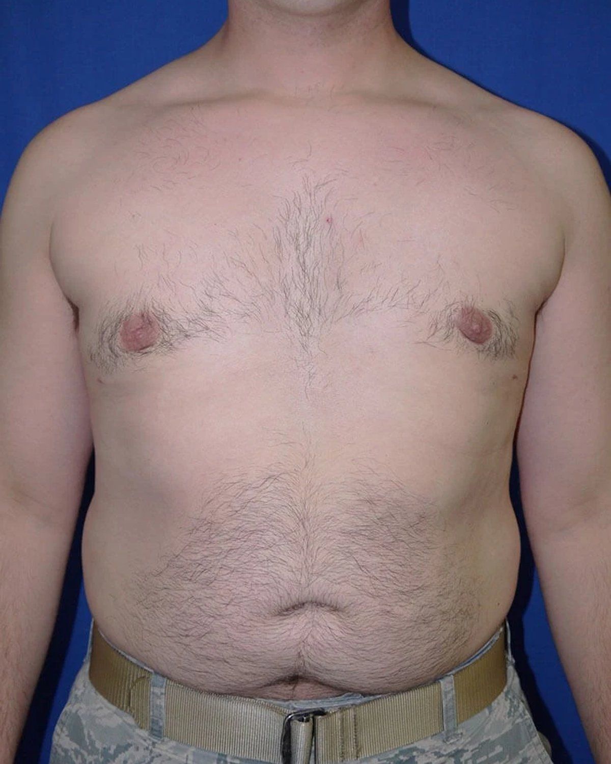One-Stitch Gynecomastia after