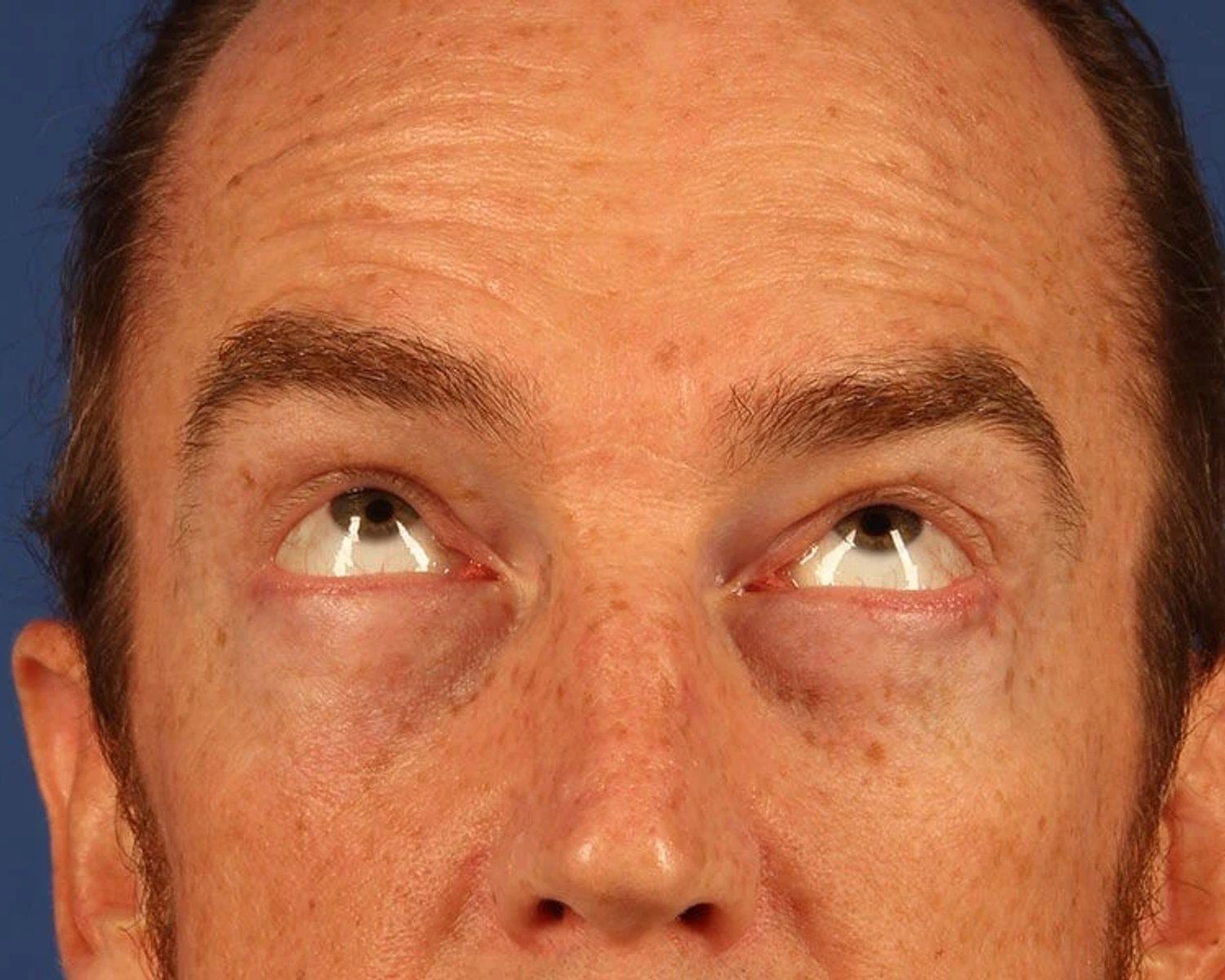 Eyelid Surgery after