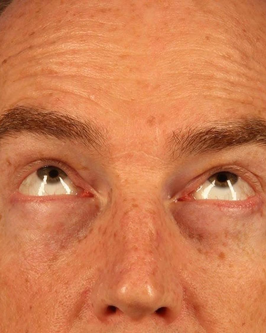 After Eyelid Surgery