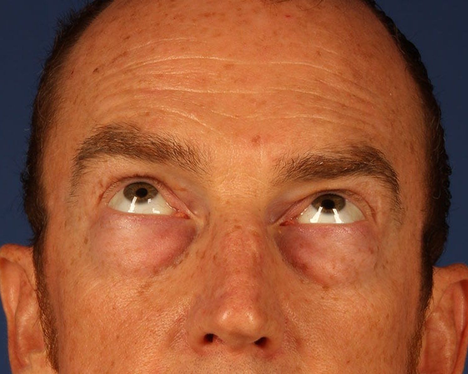Eyelid Surgery before