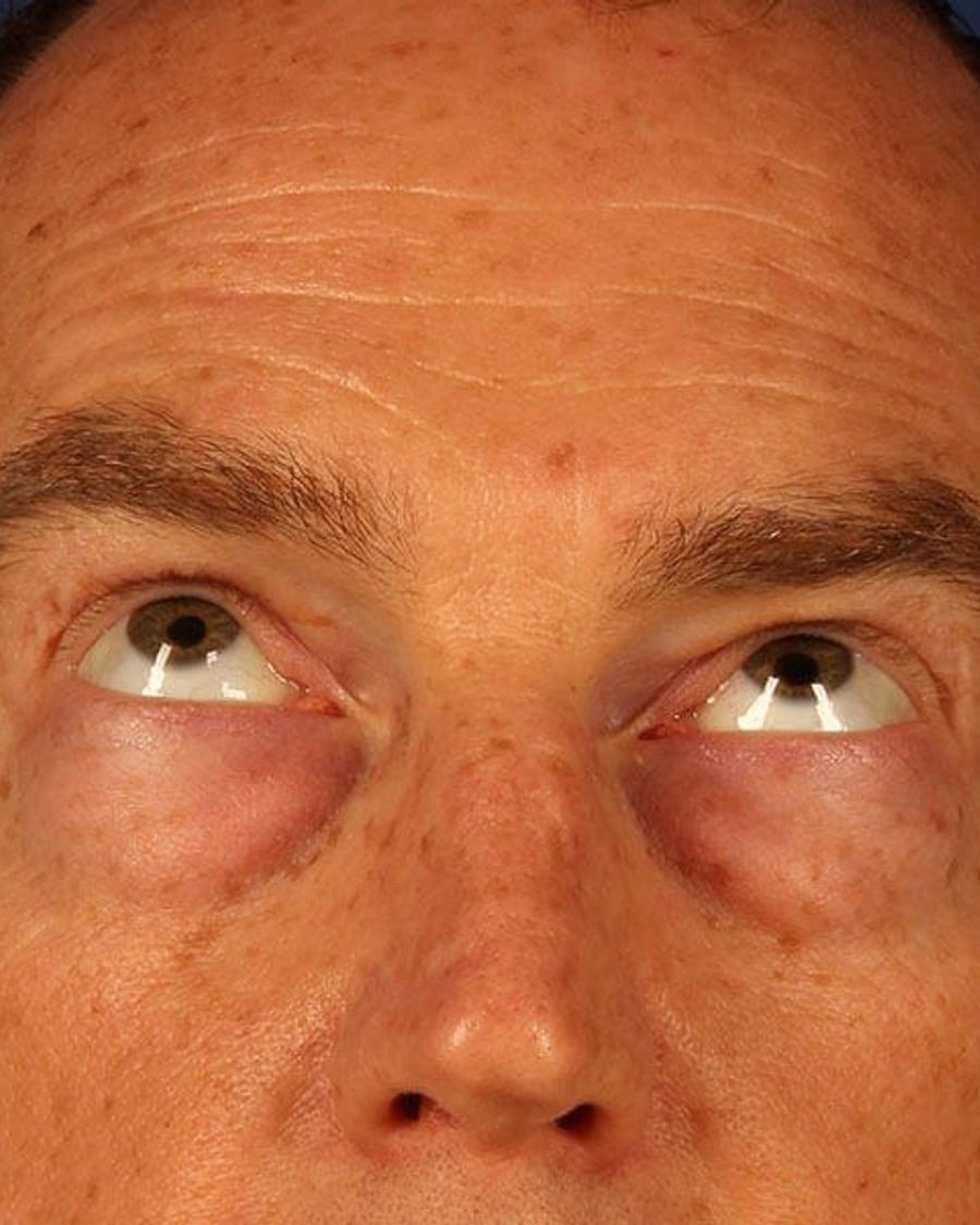 Before Eyelid Surgery