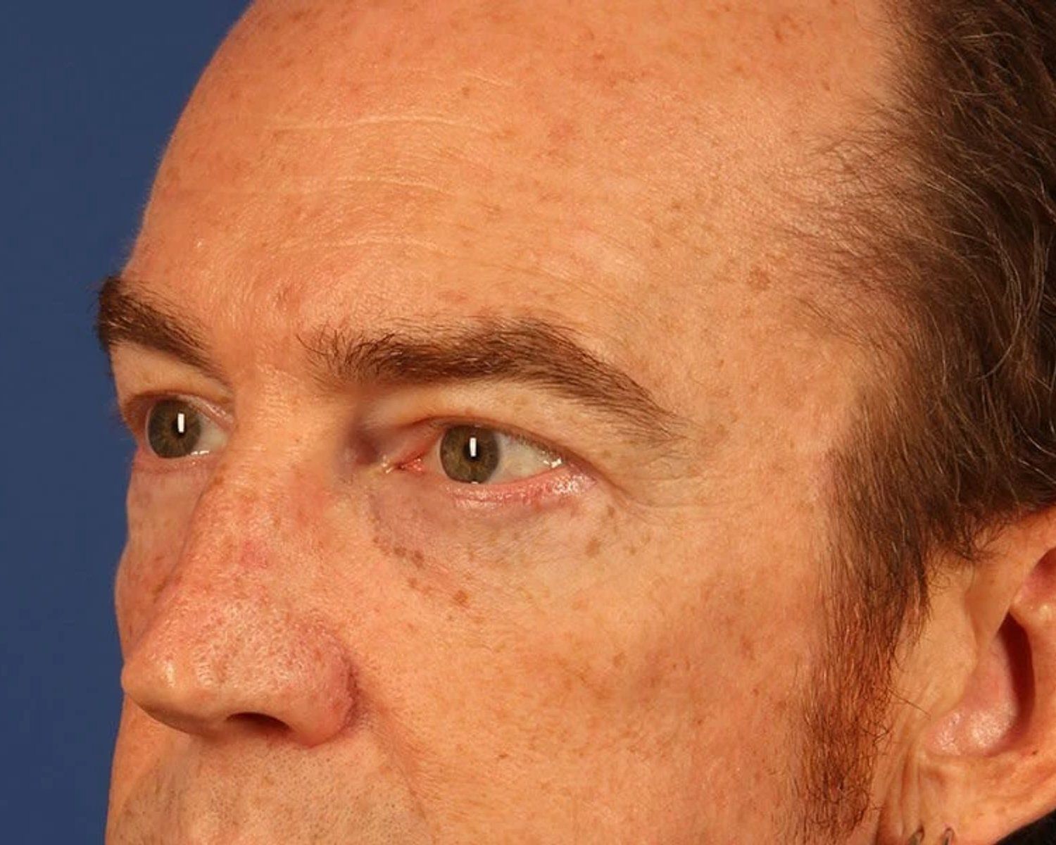 Eyelid Surgery, Oblique Right view, after