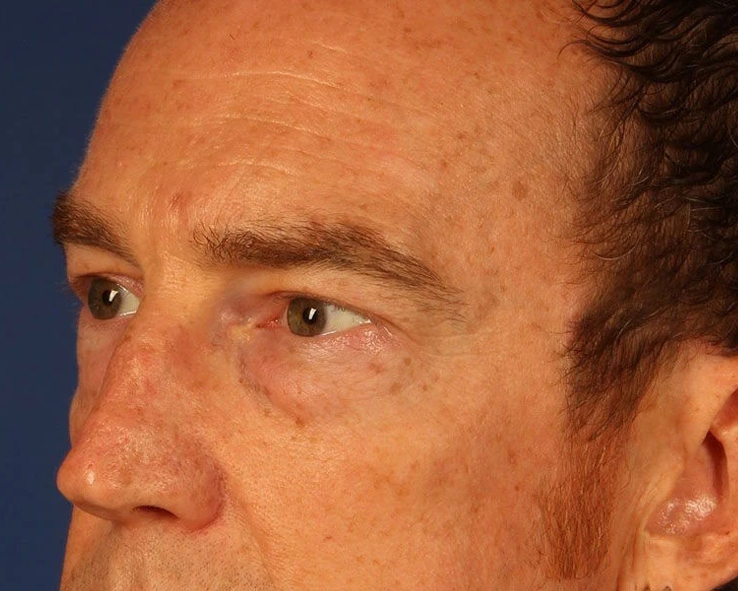 Eyelid Surgery, Oblique Right view, before