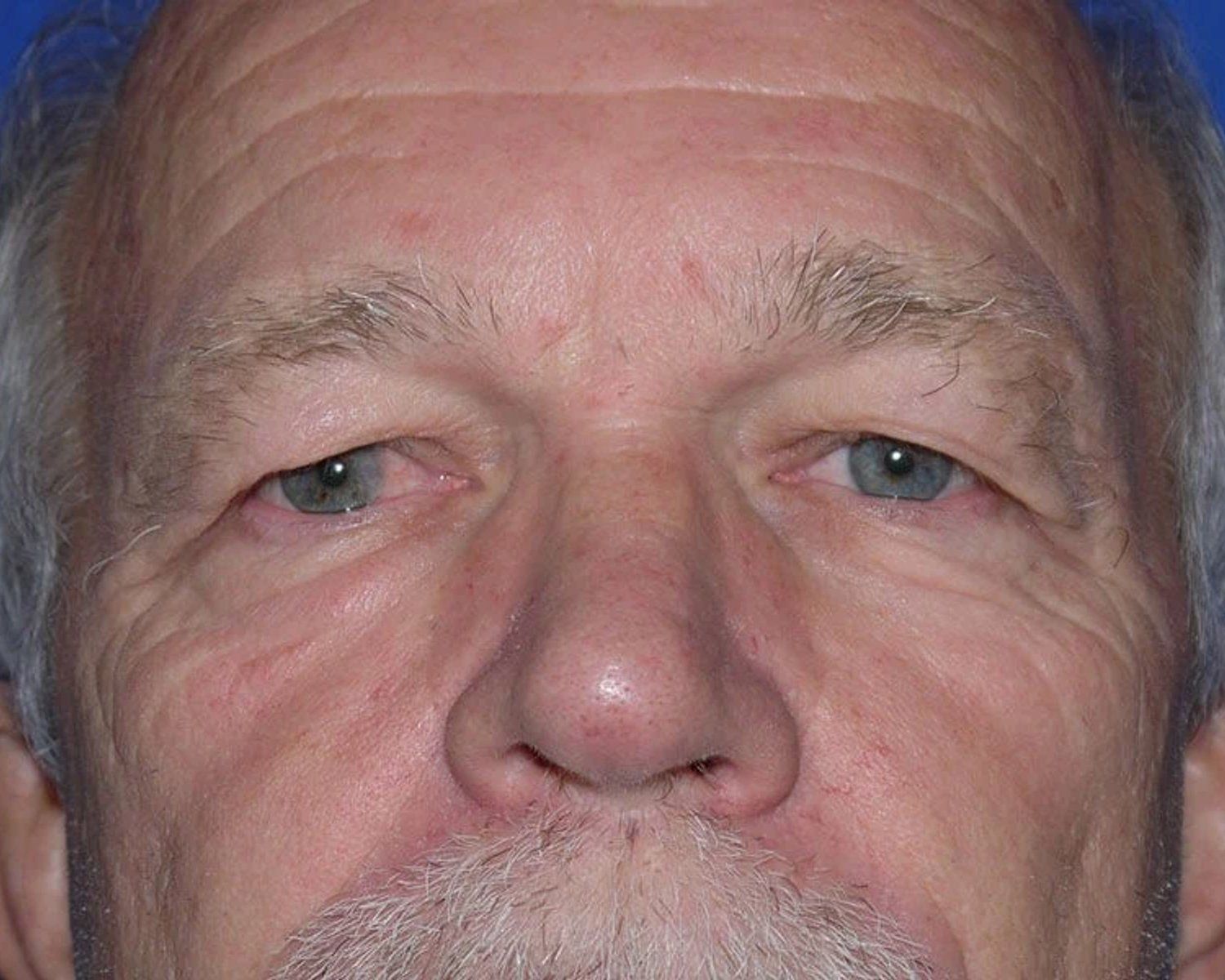 Eyelid Surgery before