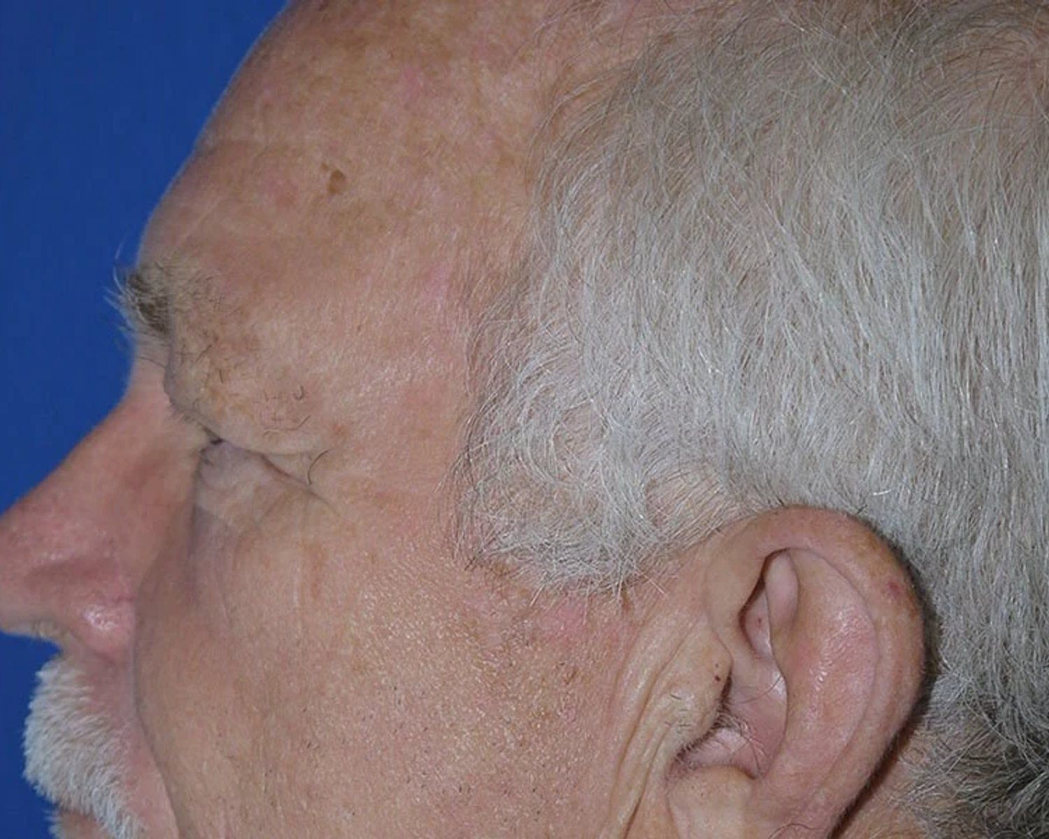 Eyelid Surgery, Oblique Left view, before
