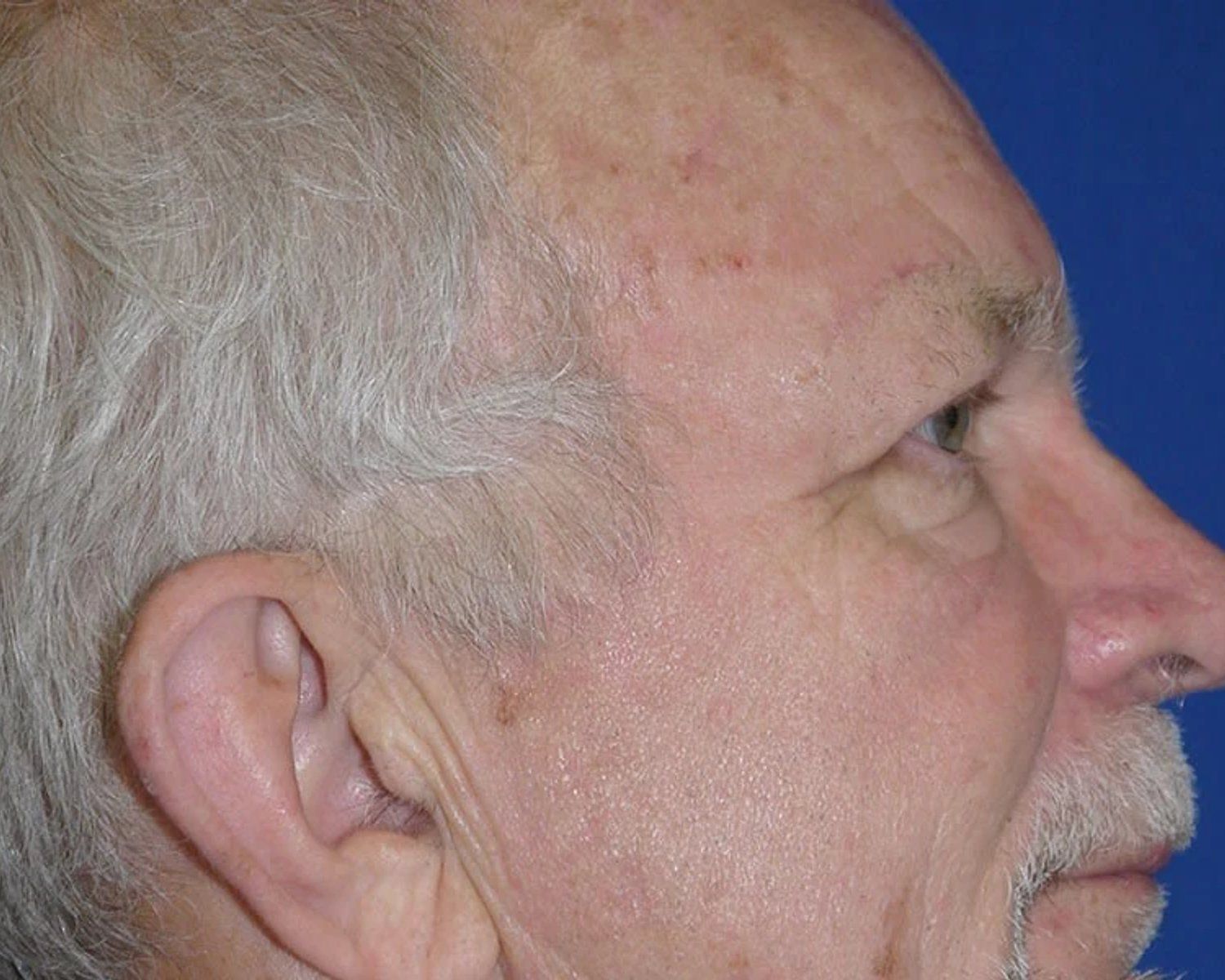 Eyelid Surgery, Oblique Right view, after