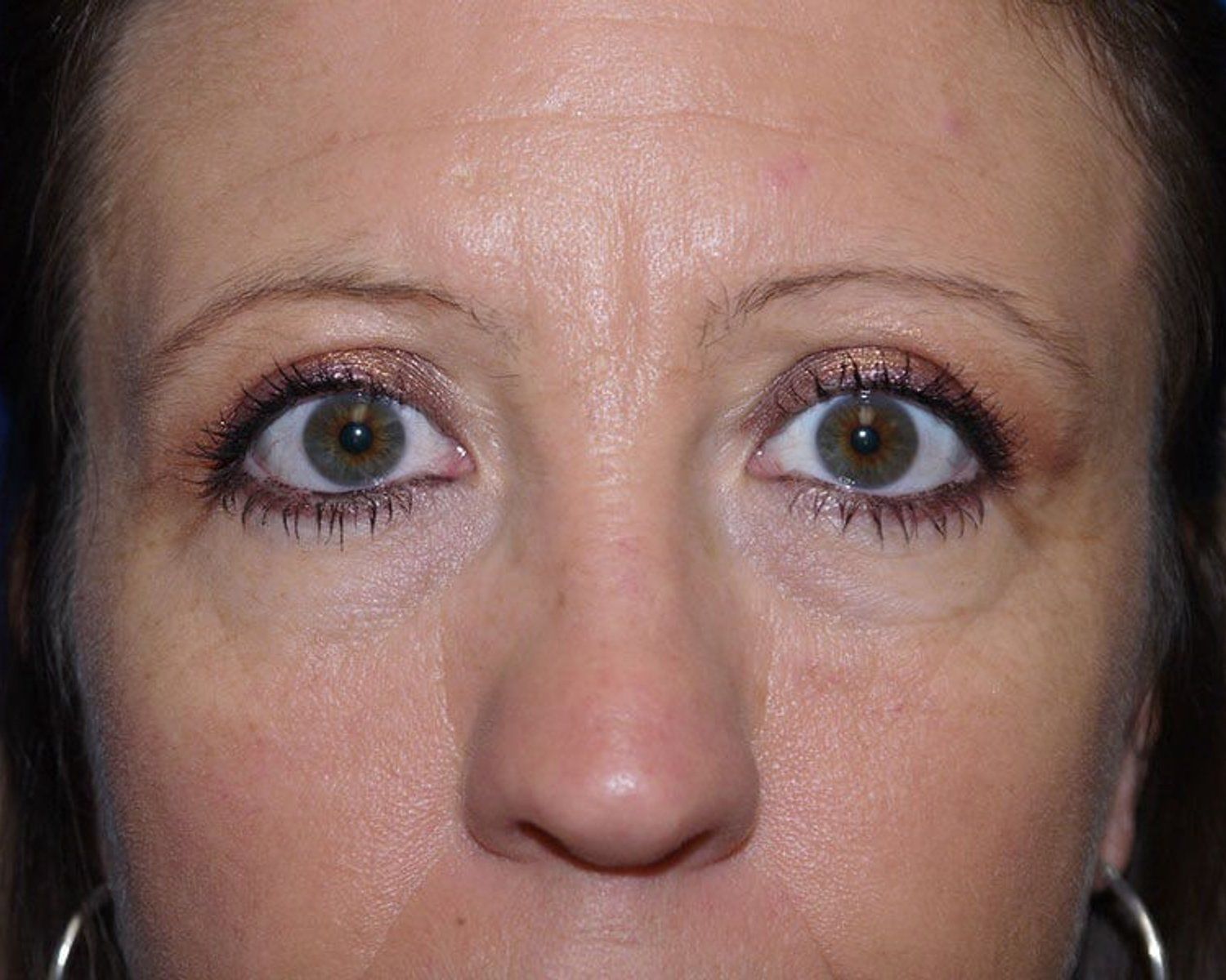 Eyelid Surgery after