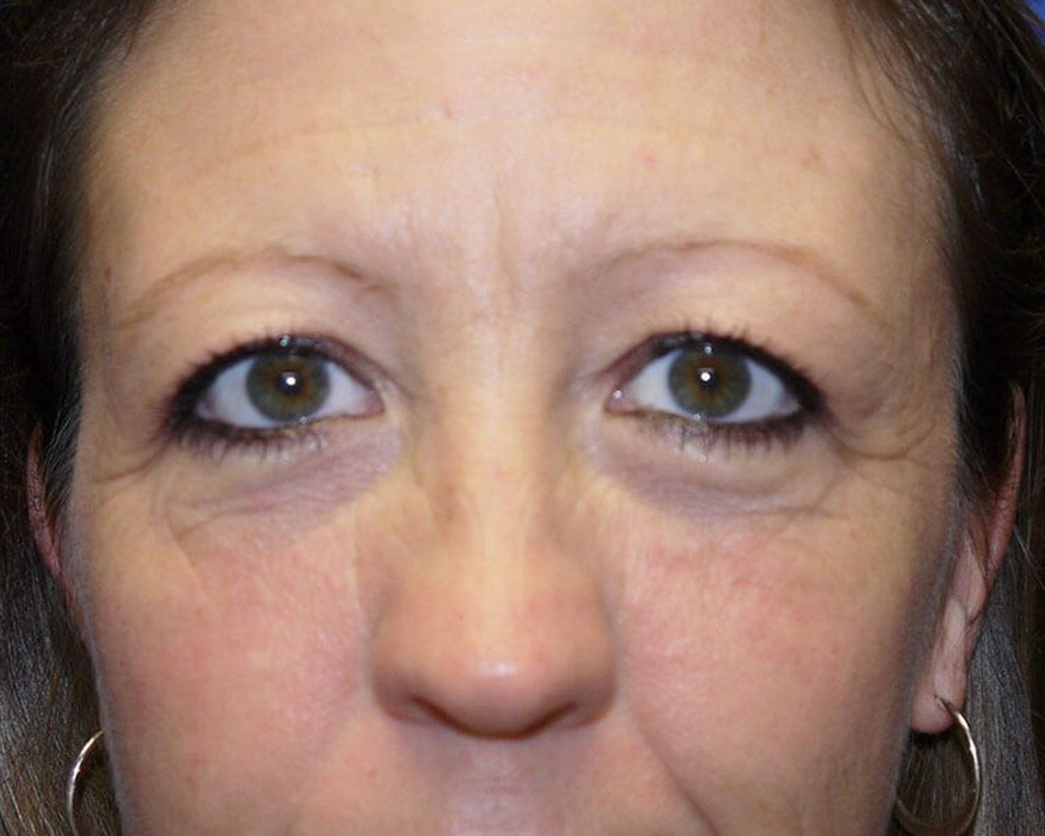 Eyelid Surgery before