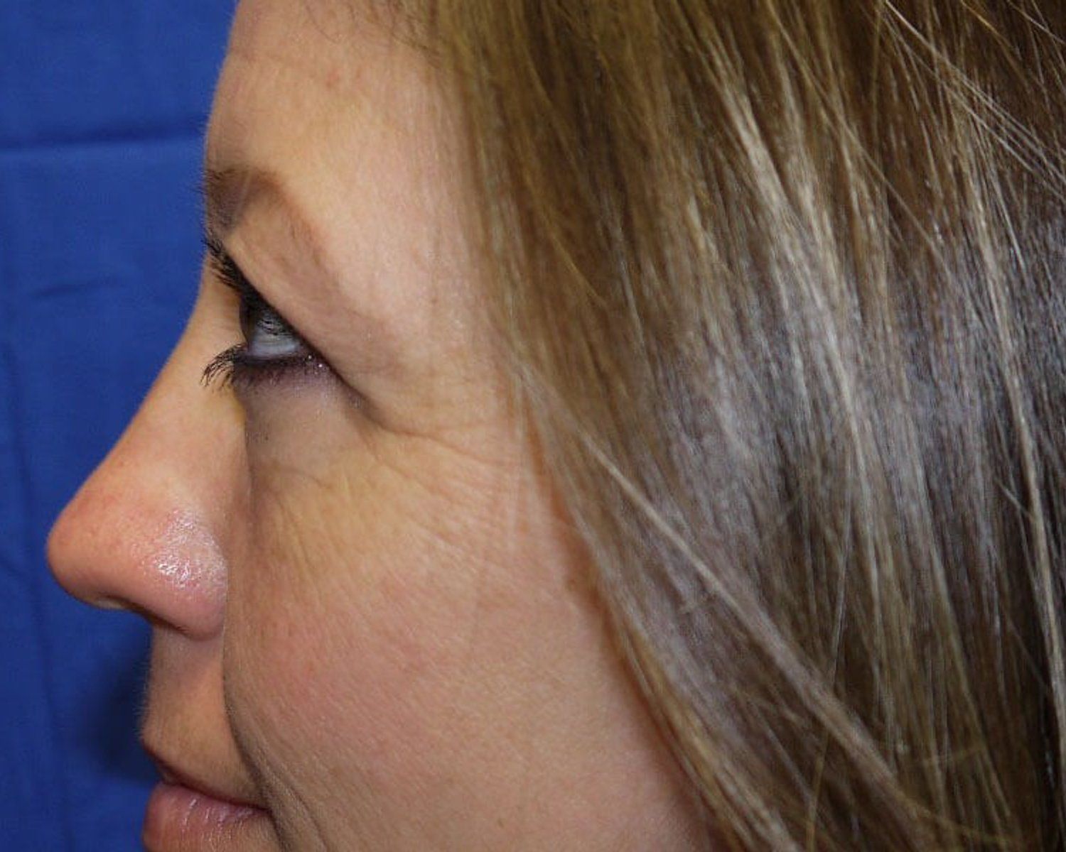 Eyelid Surgery, Oblique Left view, before