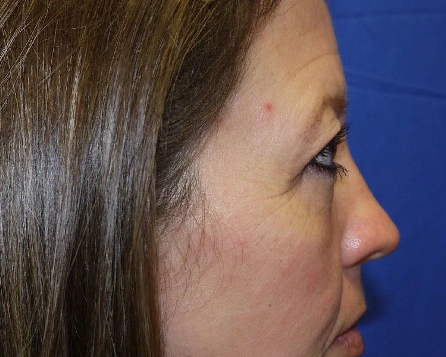 Eyelid Surgery, Oblique Right view, before
