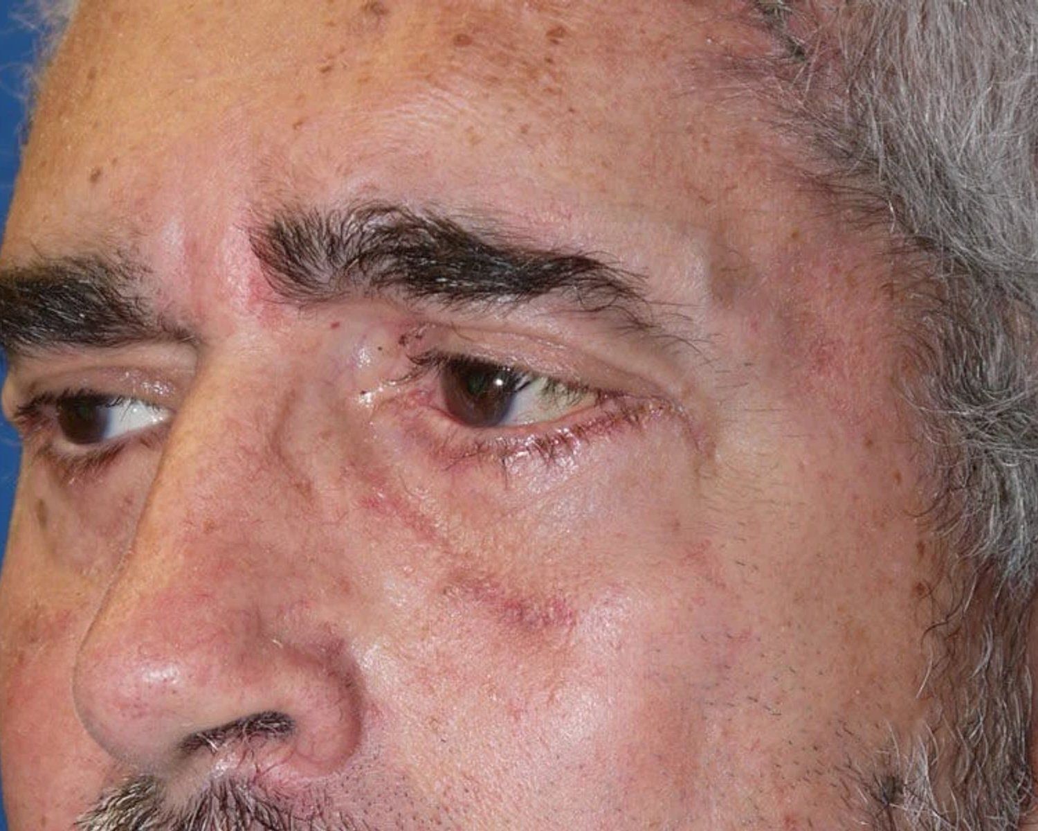 Eyelid Surgery, Oblique Right view, after
