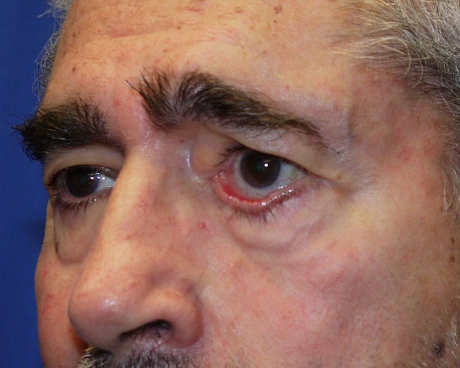 Eyelid Surgery, Oblique Right view, before